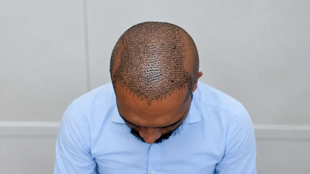 Scalp showing freshly placed grafts after an FUE hair transplant procedure.