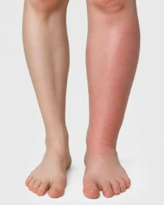 Close up cankle pictures showing lost ankle definition from swelling