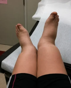 Real world cankle pictures showing legs elevated during a medical exam