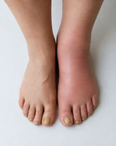 Cankle pictures from above comparing a swollen foot to a normal foot