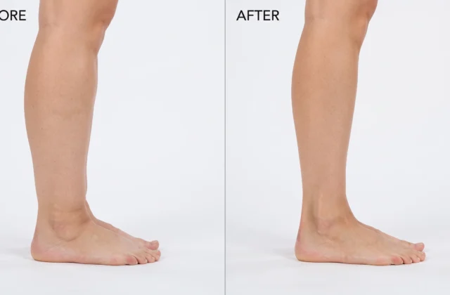 Cankle Surgery and Liposuction