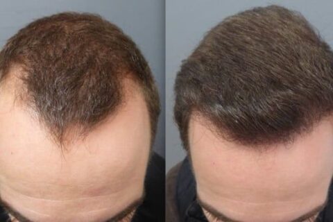 Before and after results of an FUE hair transplant showing hair regrowth