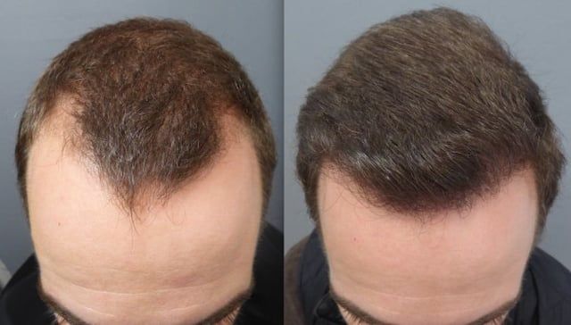 Before and after results of an FUE hair transplant showing hair regrowth