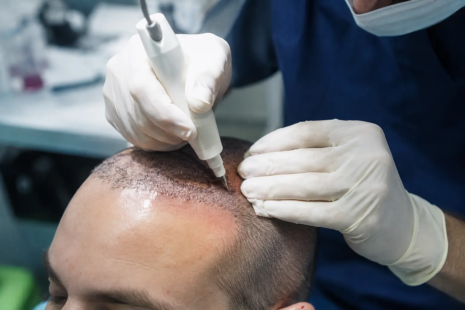 DHI hair transplant procedure showing a surgeon using a Choi implanter pen to place hair grafts along the hairline, with a gloved hand steadying the patient's head and visible graft rows already implanted near the forehead