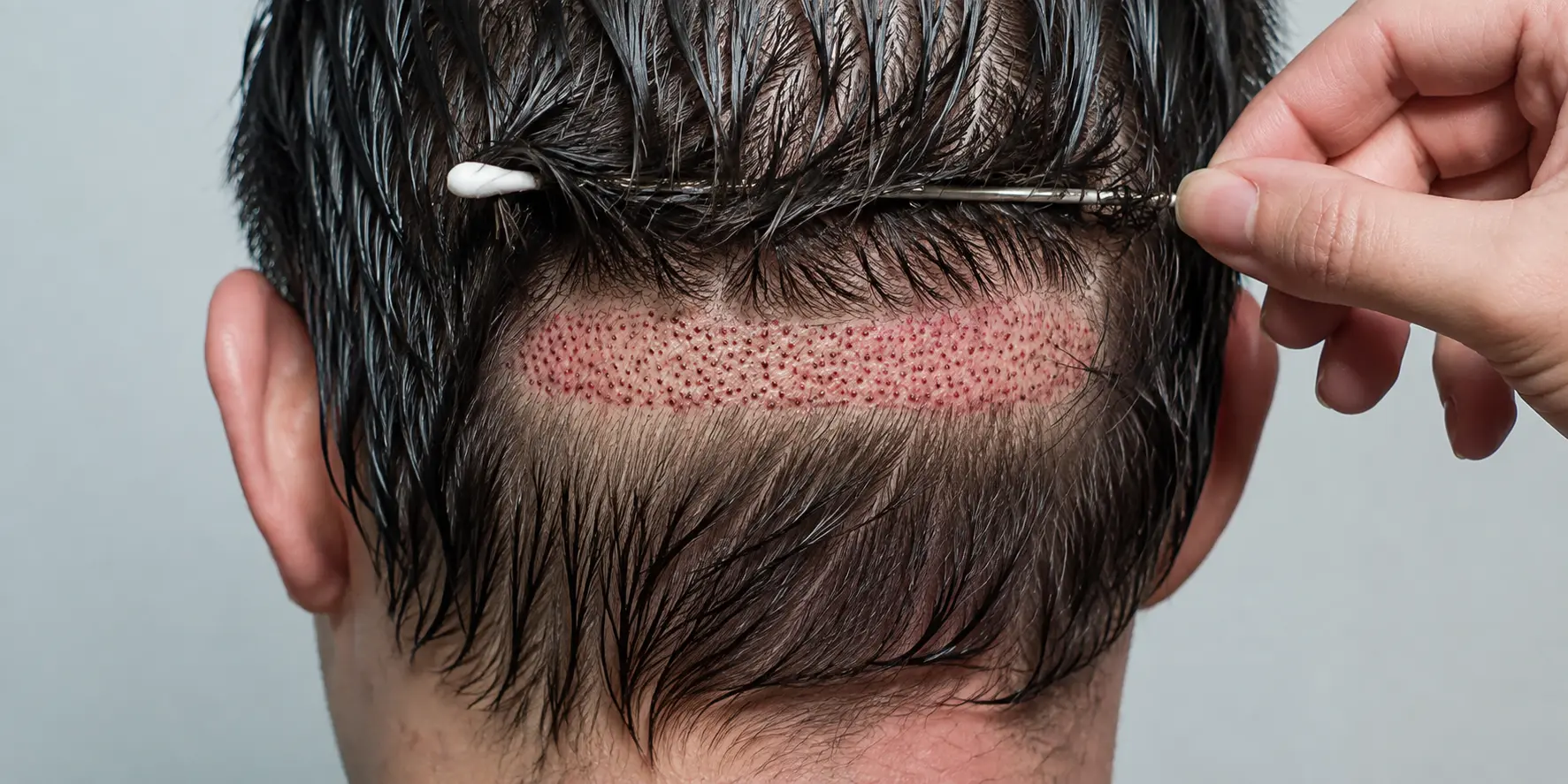 FUT hair transplant donor scar shown as a horizontal strip of small red healing punctures across the back of the scalp, with surrounding hair parted aside and a cotton swab cleaning the freshly closed incision line