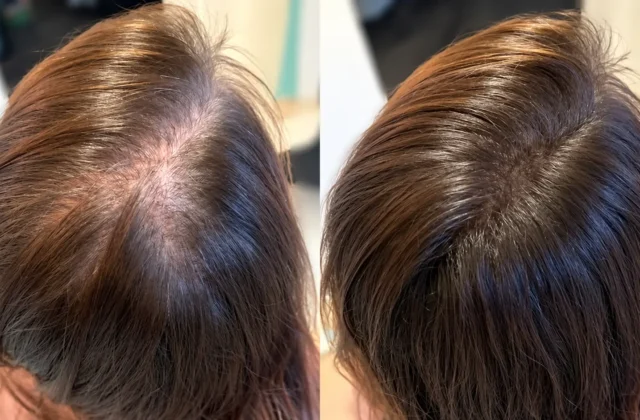 Hair Transplant for Women before and after comparison showing the crown area of a woman’s scalp with visible hair thinning and reduced density on the left, followed by noticeably fuller hair coverage on the right. The overhead close-up highlights changes in scalp visibility, hair density, and overall coverage in a realistic female hair restoration comparison.
