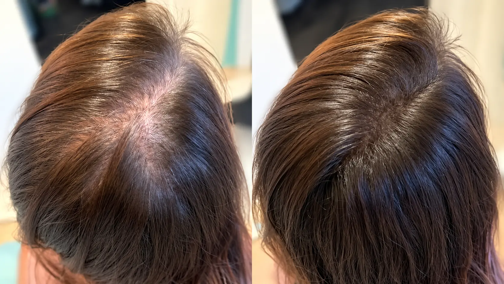 Hair Transplant for Women before and after comparison showing the crown area of a woman’s scalp with visible hair thinning and reduced density on the left, followed by noticeably fuller hair coverage on the right. The overhead close-up highlights changes in scalp visibility, hair density, and overall coverage in a realistic female hair restoration comparison.